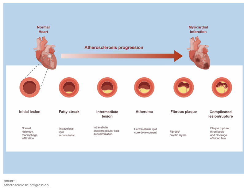 Progress in stem-cell therapy for atherosclerosis