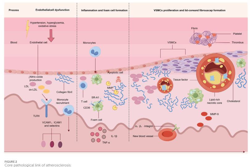 Progression of atherosclerosis
